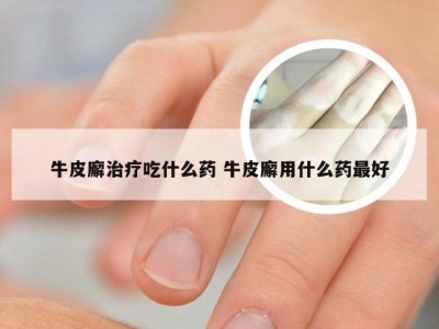 牛皮廨治疗吃什么药 牛皮廨用什么药最好