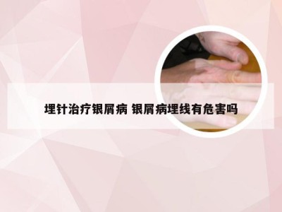 埋针治疗银屑病 银屑病埋线有危害吗