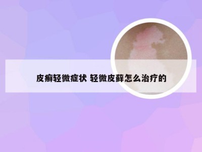 皮癣轻微症状 轻微皮藓怎么治疗的