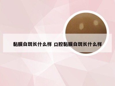 黏膜白斑长什么样 口腔黏膜白斑长什么样