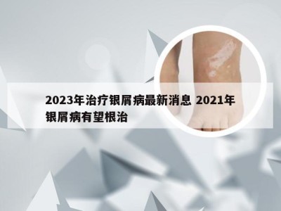 2023年治疗银屑病最新消息 2021年银屑病有望根治