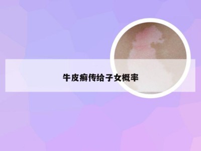 牛皮癣传给子女概率