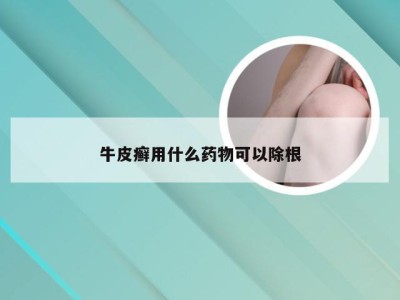 牛皮癣用什么药物可以除根