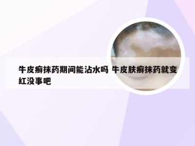 牛皮癣抹药期间能沾水吗 牛皮肤癣抹药就变红没事吧