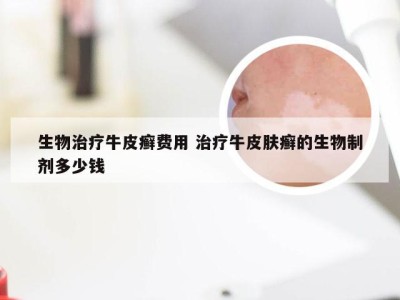 生物治疗牛皮癣费用 治疗牛皮肤癣的生物制剂多少钱