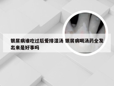 银屑病谁吃过后爱排湿汤 银屑病喝汤药全发出来是好事吗