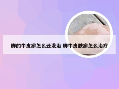 脚的牛皮癣怎么还没治 脚牛皮肤癣怎么治疗