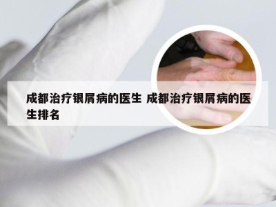 成都治疗银屑病的医生 成都治疗银屑病的医生排名