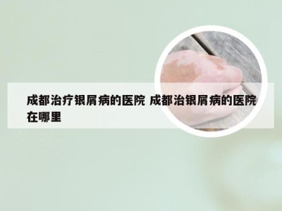 成都治疗银屑病的医院 成都治银屑病的医院在哪里