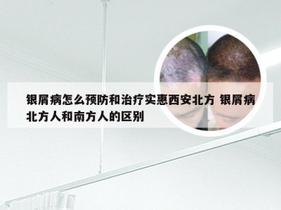 银屑病怎么预防和治疗实惠西安北方 银屑病北方人和南方人的区别