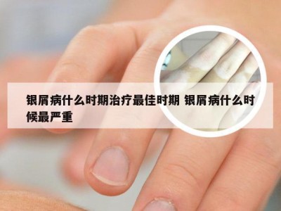 银屑病什么时期治疗最佳时期 银屑病什么时候最严重