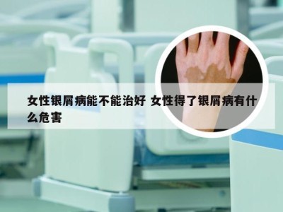 女性银屑病能不能治好 女性得了银屑病有什么危害