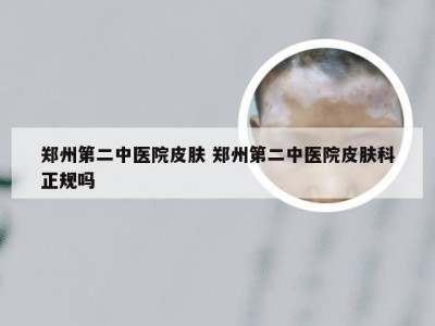 郑州第二中医院皮肤 郑州第二中医院皮肤科正规吗