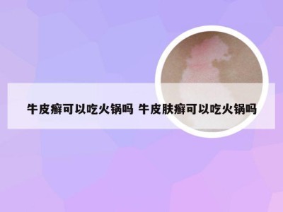 牛皮癣可以吃火锅吗 牛皮肤癣可以吃火锅吗