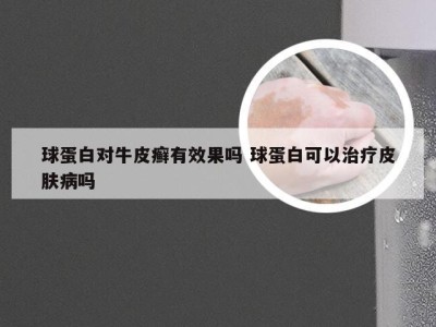 球蛋白对牛皮癣有效果吗 球蛋白可以治疗皮肤病吗