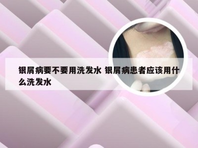 银屑病要不要用洗发水 银屑病患者应该用什么洗发水