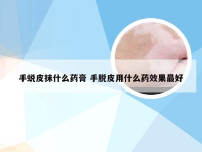 手蜕皮抹什么药膏 手脱皮用什么药效果最好