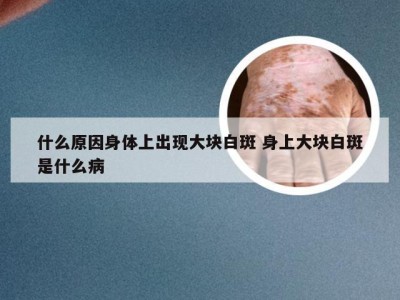 什么原因身体上出现大块白斑 身上大块白斑是什么病