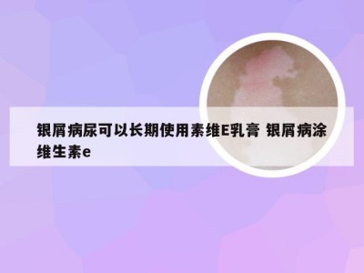 银屑病尿可以长期使用素维E乳膏 银屑病涂维生素e