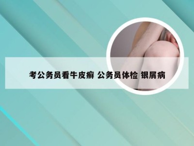 考公务员看牛皮癣 公务员体检 银屑病