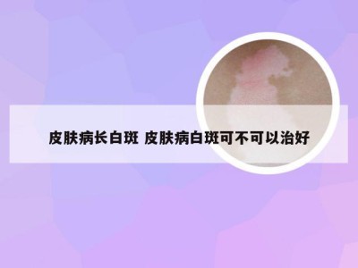 皮肤病长白斑 皮肤病白斑可不可以治好