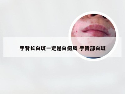 手背长白斑一定是白癜风 手背部白斑