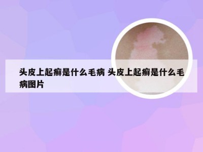 头皮上起癣是什么毛病 头皮上起癣是什么毛病图片