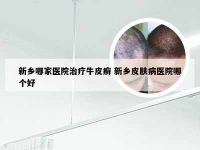 新乡哪家医院治疗牛皮癣 新乡皮肤病医院哪个好