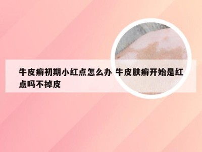 牛皮癣初期小红点怎么办 牛皮肤癣开始是红点吗不掉皮