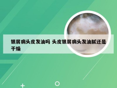 银屑病头皮发油吗 头皮银屑病头发油腻还是干燥