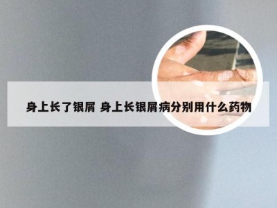 身上长了银屑 身上长银屑病分别用什么药物