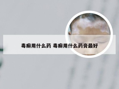 毒癣用什么药 毒癣用什么药膏最好