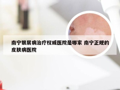 南宁银屑病治疗权威医院是哪家 南宁正规的皮肤病医院