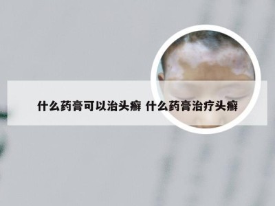 什么药膏可以治头癣 什么药膏治疗头癣