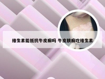 维生素能抵抗牛皮癣吗 牛皮肤癣吃维生素