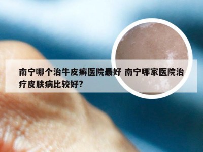 南宁哪个治牛皮癣医院最好 南宁哪家医院治疗皮肤病比较好?