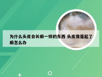 为什么头皮会长癣一样的东西 头皮像是起了癣怎么办