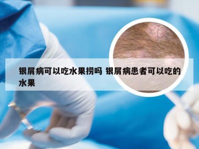 银屑病可以吃水果捞吗 银屑病患者可以吃的水果