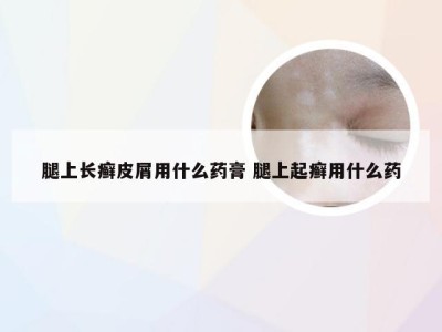 腿上长癣皮屑用什么药膏 腿上起癣用什么药