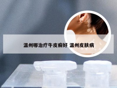 温州哪治疗牛皮癣好 温州皮肤病