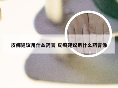 皮癣建议用什么药膏 皮癣建议用什么药膏涂