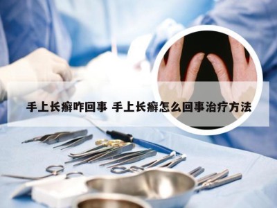 手上长癣咋回事 手上长癣怎么回事治疗方法