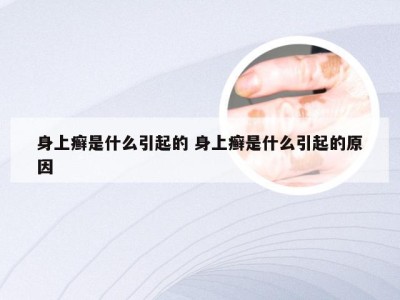 身上癣是什么引起的 身上癣是什么引起的原因