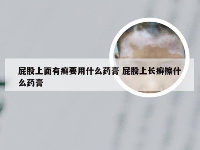 屁股上面有癣要用什么药膏 屁股上长癣擦什么药膏