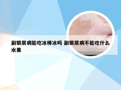 副银屑病能吃冰棒冰吗 副银屑病不能吃什么水果