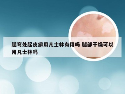 腿弯处起皮癣用凡士林有用吗 腿部干燥可以用凡士林吗