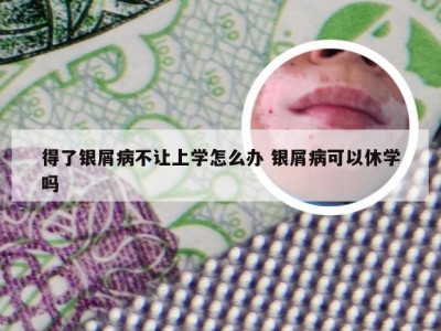 得了银屑病不让上学怎么办 银屑病可以休学吗