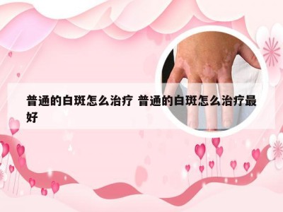 普通的白斑怎么治疗 普通的白斑怎么治疗最好