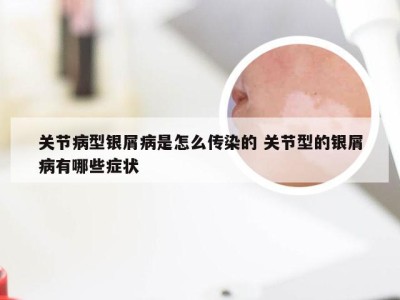 关节病型银屑病是怎么传染的 关节型的银屑病有哪些症状