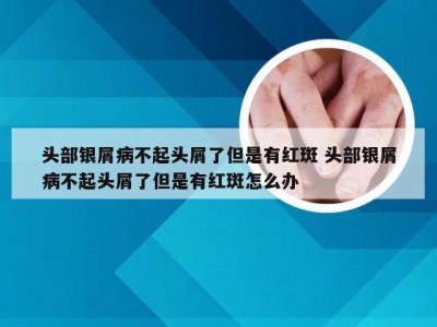 头部银屑病不起头屑了但是有红斑 头部银屑病不起头屑了但是有红斑怎么办